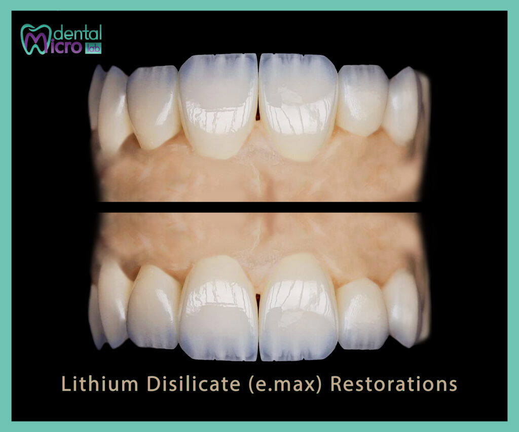 Read more about the article Lithium Disilicate (e.max) Restorations: Longevity, Indications & Clinical Pearls