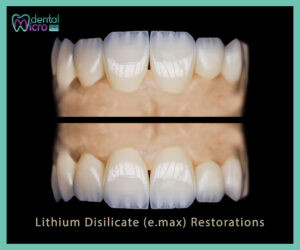 Lithium Disilicate (e.max) Restorations: Longevity, Indications & Clinical Pearls