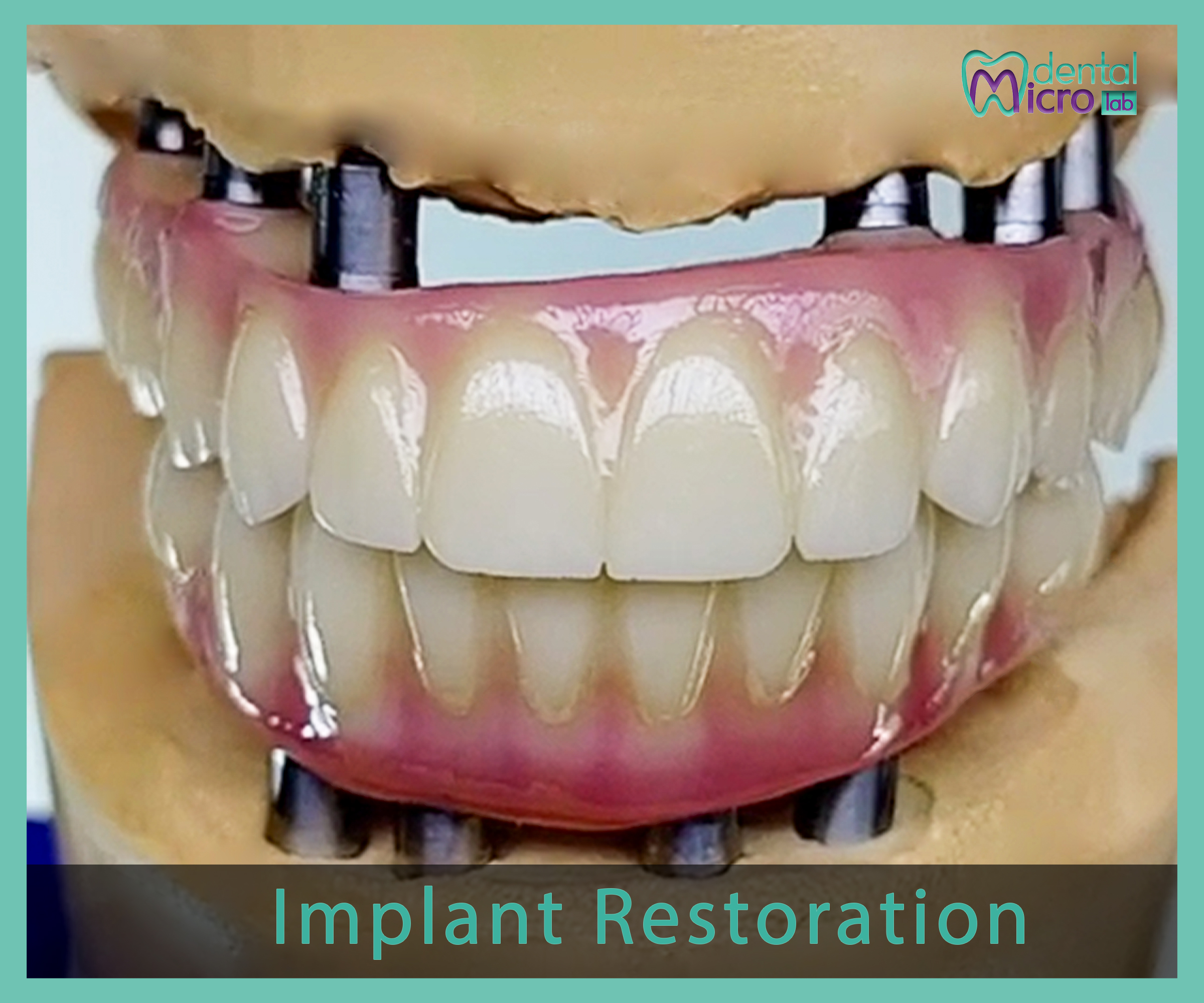 Implant- زراعة الاسنان - Jeddah - dental lab - افضل معمل في جدة تركيبات الاسنان للاطباء
