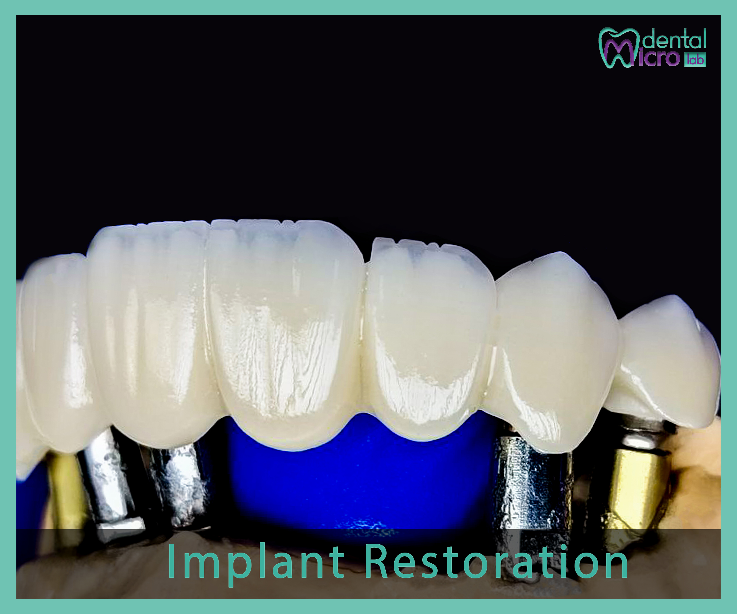 Implant- زراعة الاسنان - Jeddah - dental lab - افضل معمل في جدة تركيبات الاسنان للاطباء