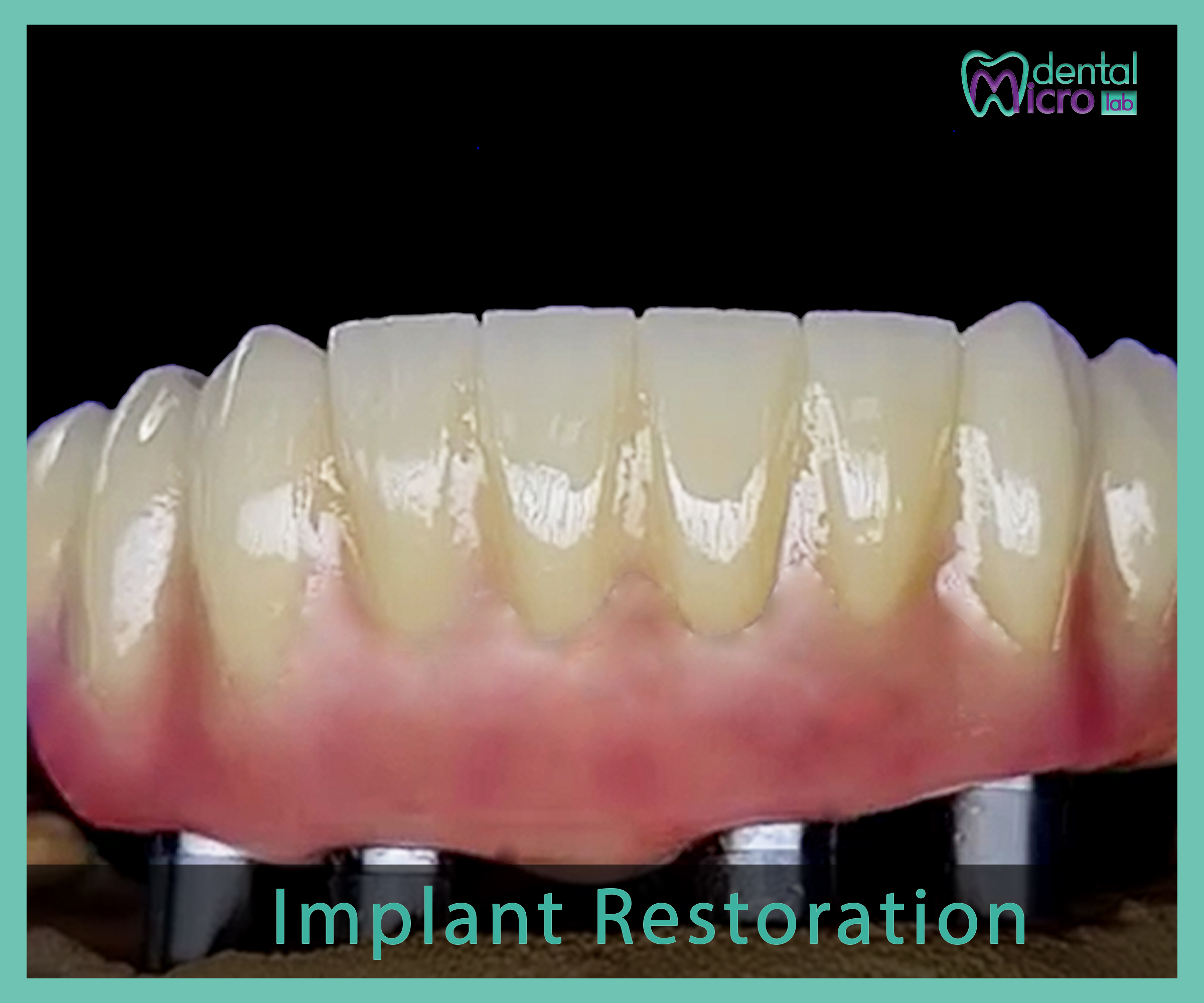 Implant- زراعة الاسنان - Jeddah - dental lab - افضل معمل في جدة تركيبات الاسنان للاطباء