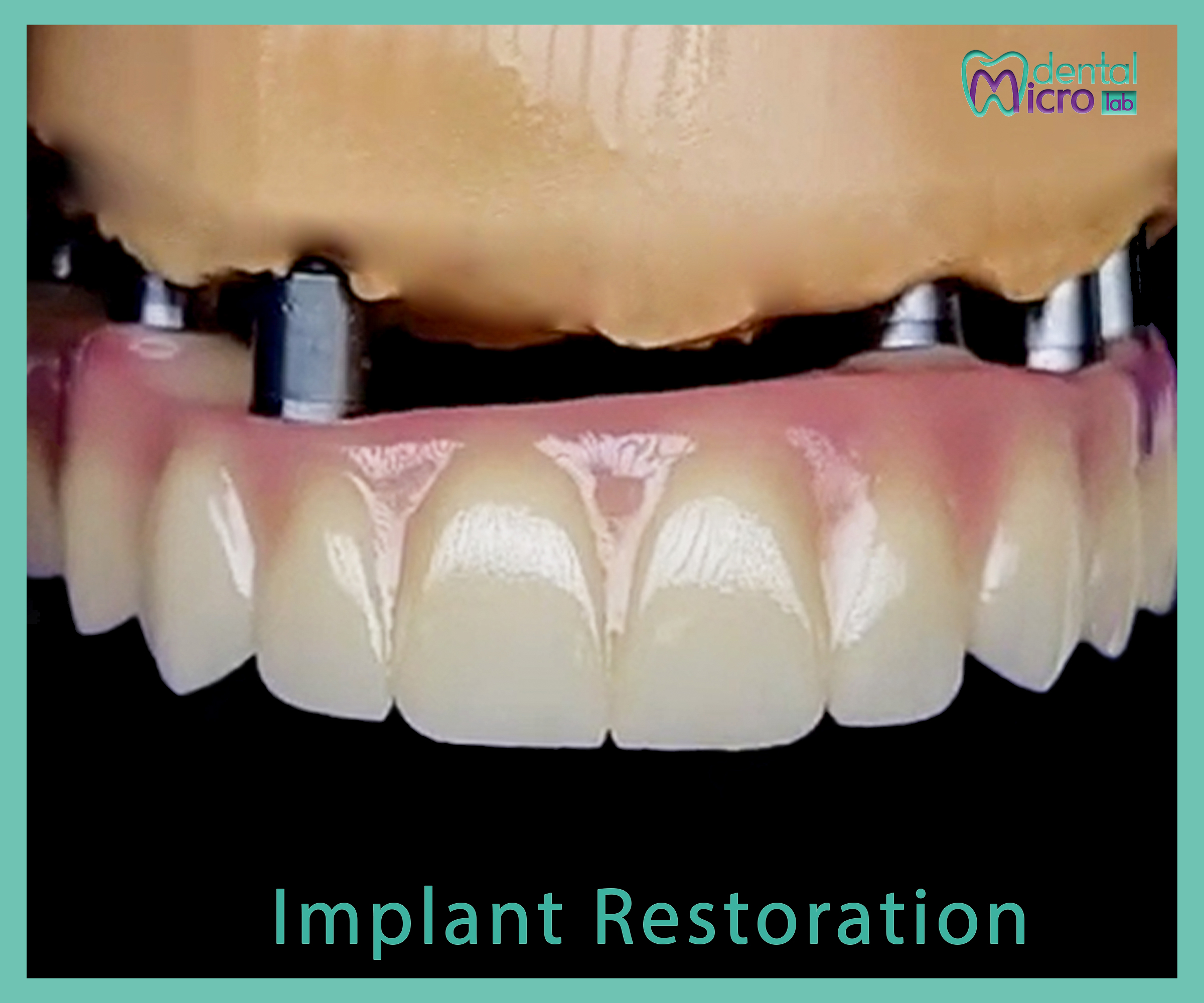 Implant- زراعة الاسنان - Jeddah - dental lab - افضل معمل في جدة تركيبات الاسنان للاطباء
