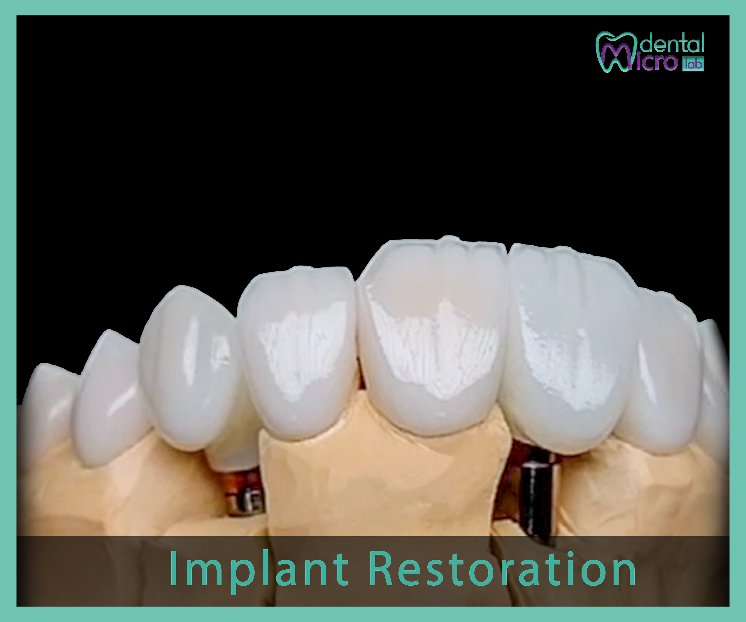 Implant- زراعة الاسنان - Jeddah - dental lab - افضل معمل في جدة تركيبات الاسنان للاطباء