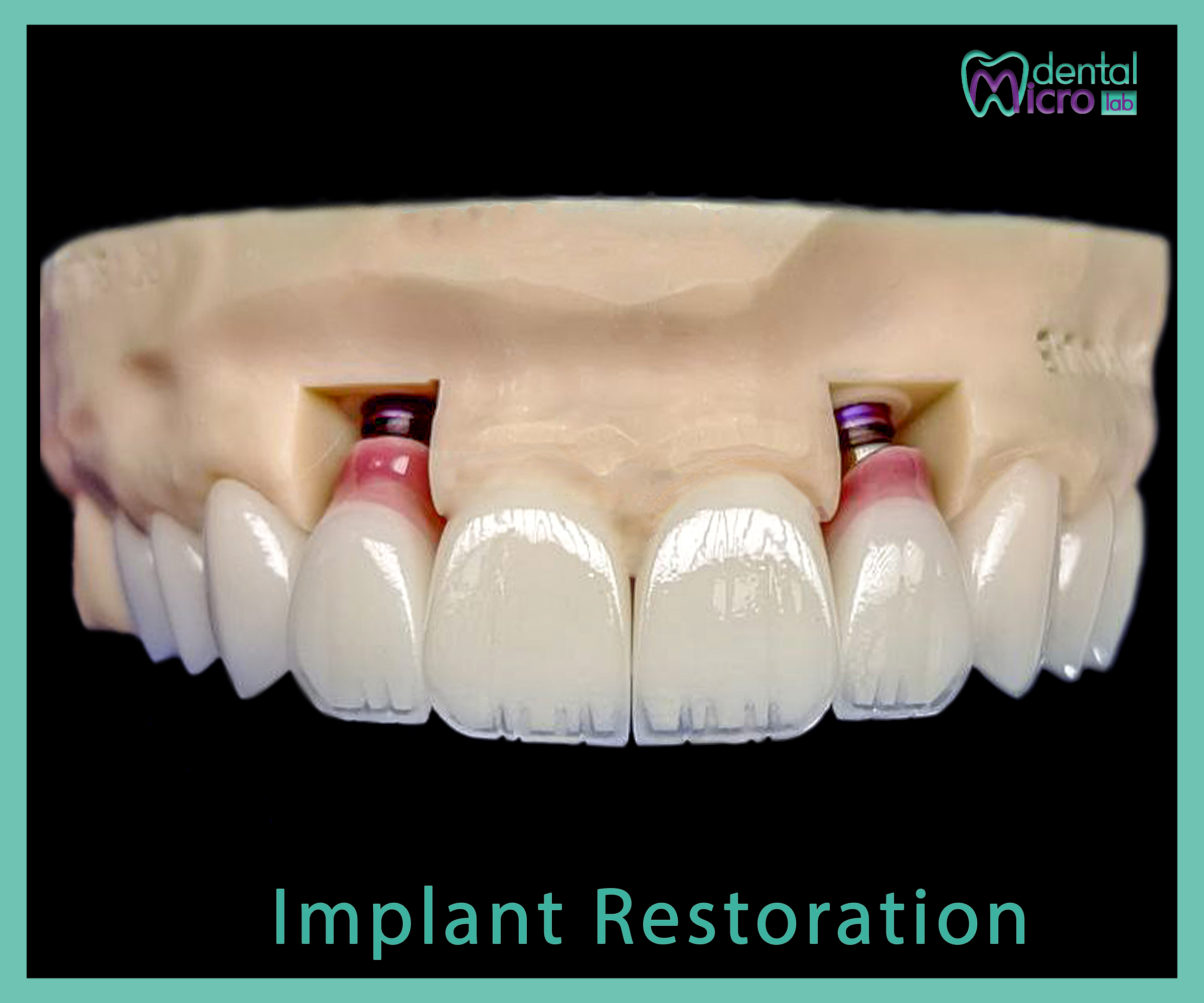 Implant- زراعة الاسنان - Jeddah - dental lab - افضل معمل في جدة تركيبات الاسنان للاطباء