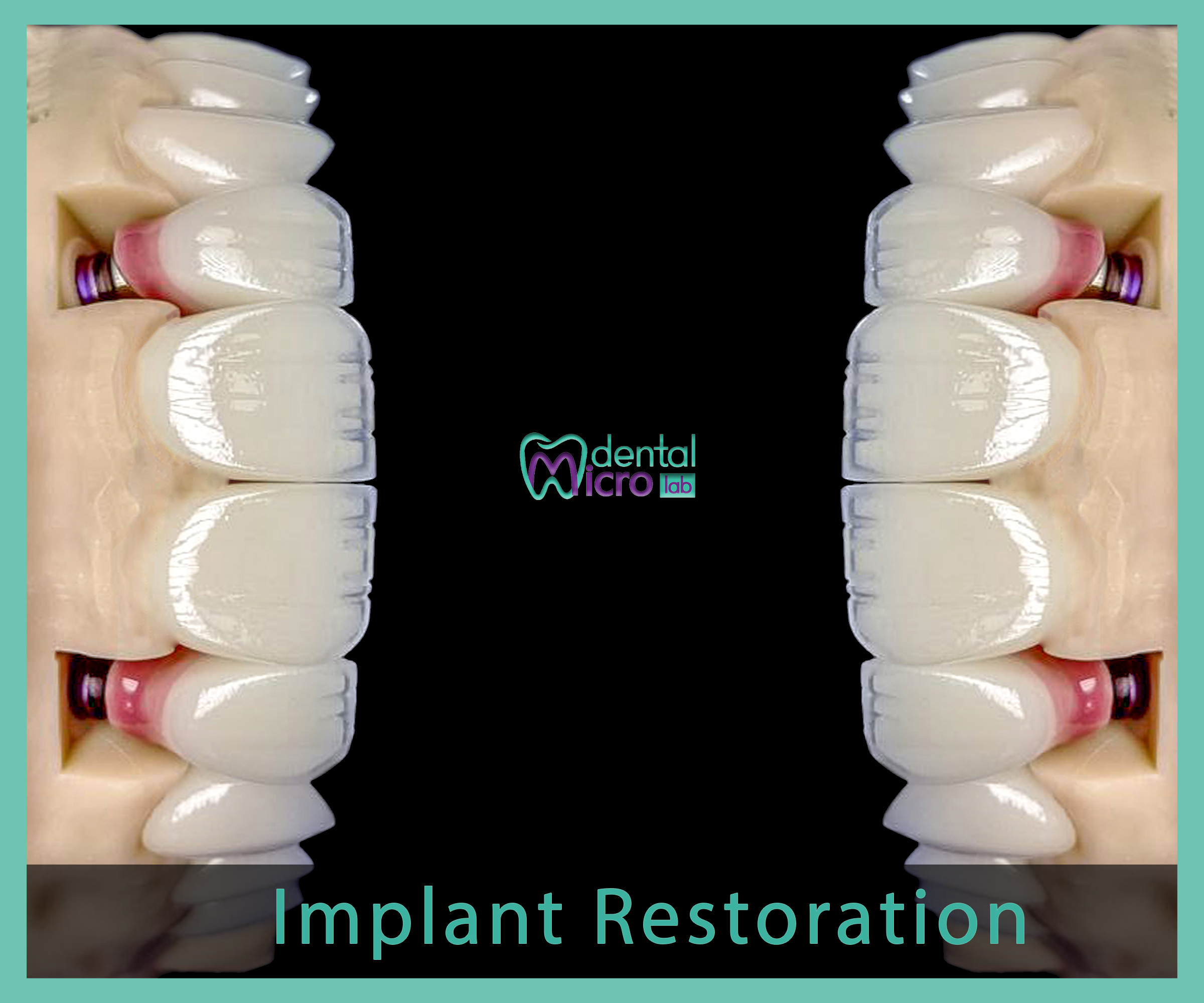 Implant- زراعة الاسنان - Jeddah - dental lab - افضل معمل في جدة تركيبات الاسنان للاطباء