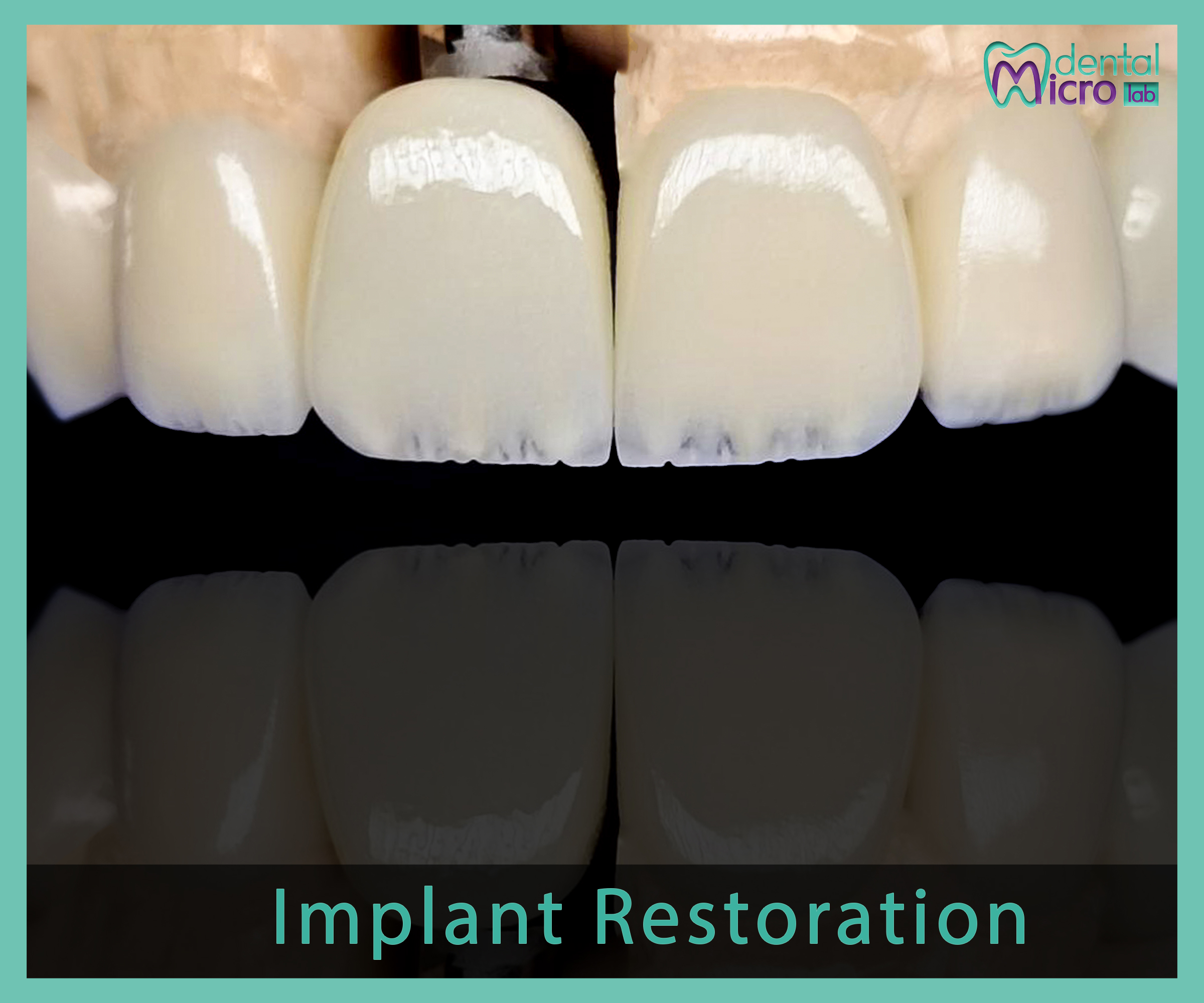 Implant- زراعة الاسنان - Jeddah - dental lab - افضل معمل في جدة تركيبات الاسنان للاطباء