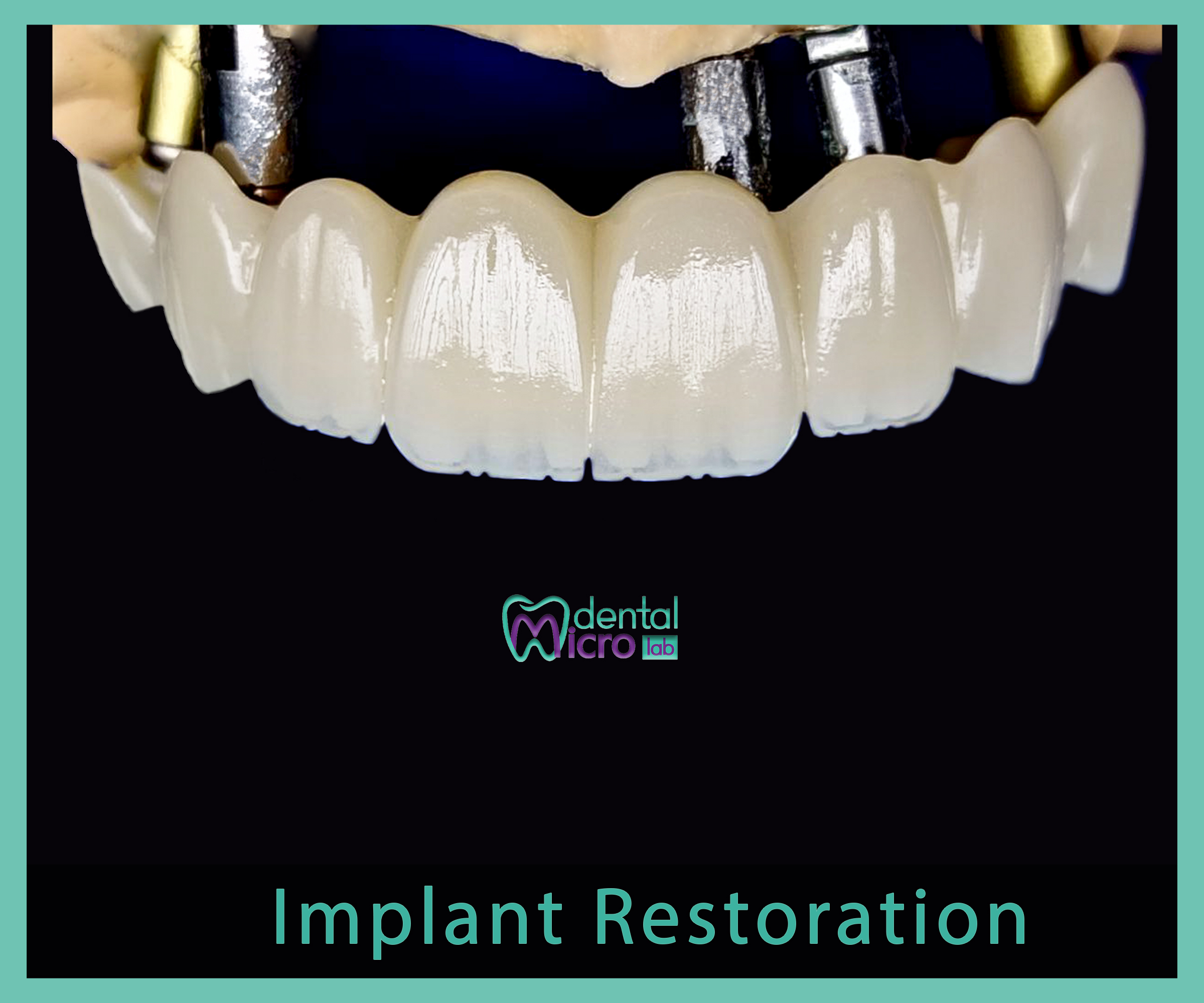 Implant- زراعة الاسنان - Jeddah - dental lab - افضل معمل في جدة تركيبات الاسنان للاطباء
