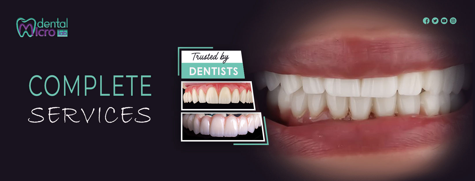 تركيبات إيماكس فينير إيماكس معمل أسنان جدة تركيبات تجميلية معمل تركيبات أسنان