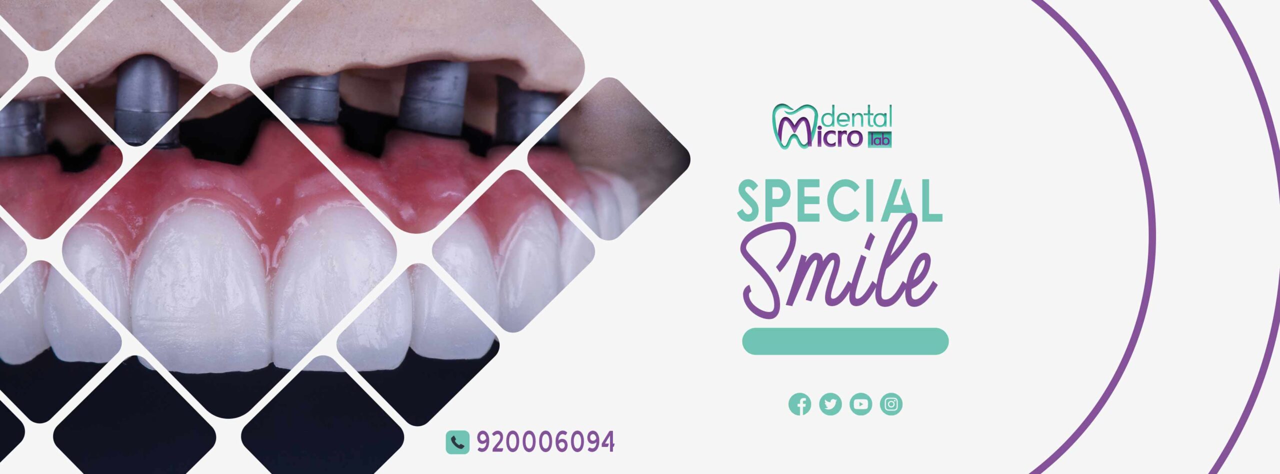 تركيبات إيماكس فينير إيماكس معمل أسنان جدة تركيبات تجميلية معمل تركيبات أسنان