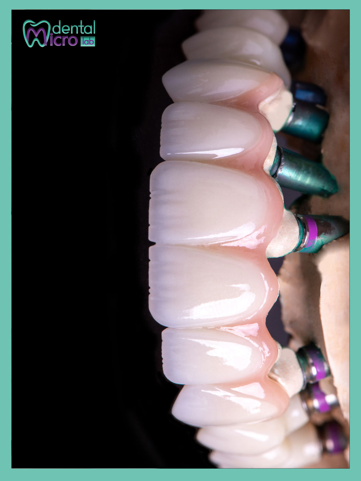 تركيبات إيماكس فينير إيماكس معمل أسنان جدة تركيبات تجميلية معمل تركيبات أسنان