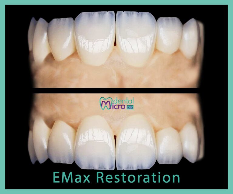 micro dental lab تركيبات زراعة الأسنان معمل زراعة الأسنان زراعة الأسنان في جدة تركيبات فوق الزرعات معمل أسنان جدة تركيبات تجميلية للأسنان dental emax