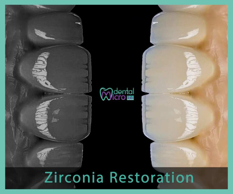 micro dental lab تركيبات زراعة الأسنان معمل زراعة الأسنان زراعة الأسنان في جدة تركيبات فوق الزرعات معمل أسنان جدة تركيبات تجميلية للأسنان dental emax