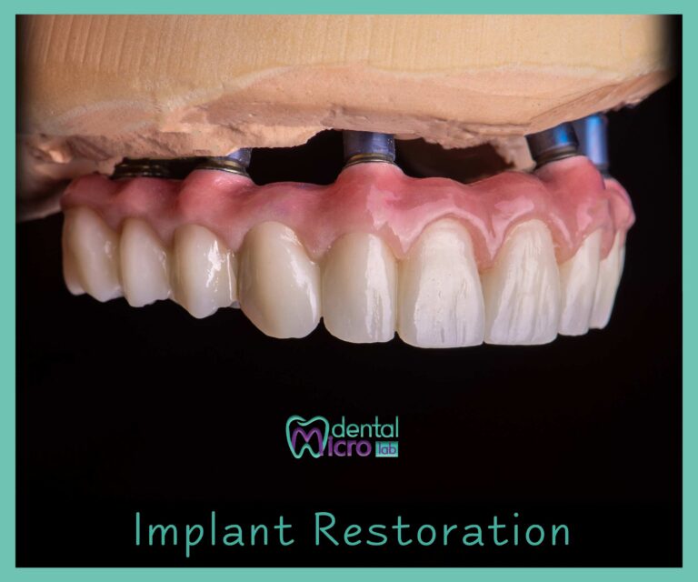 micro dental lab تركيبات زراعة الأسنان معمل زراعة الأسنان زراعة الأسنان في جدة تركيبات فوق الزرعات معمل أسنان جدة تركيبات تجميلية للأسنان dental emax