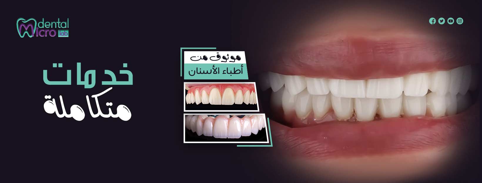 تركيبات إيماكس فينير إيماكس معمل أسنان جدة تركيبات تجميلية معمل تركيبات أسنان