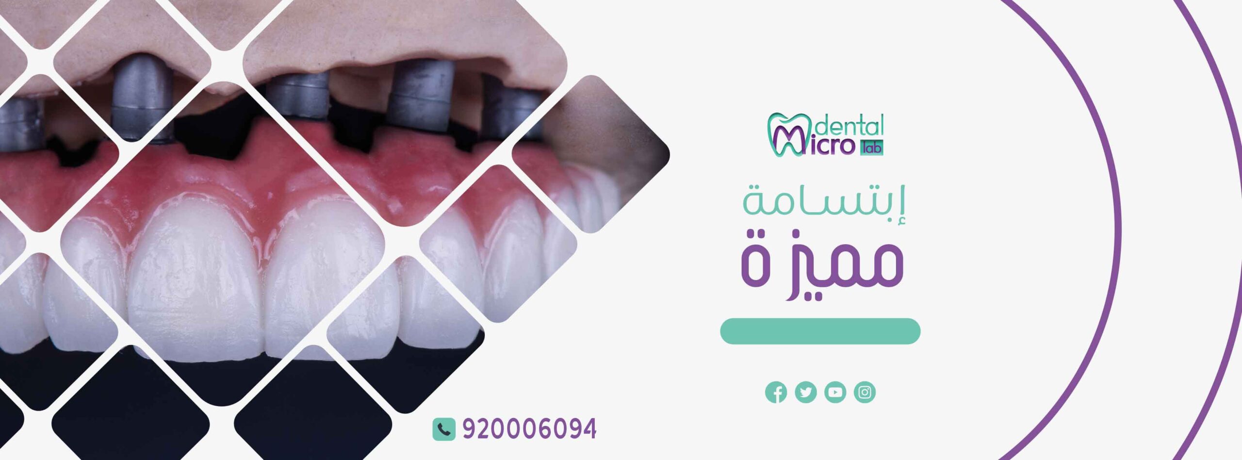 تركيبات إيماكس فينير إيماكس معمل أسنان جدة تركيبات تجميلية معمل تركيبات أسنان