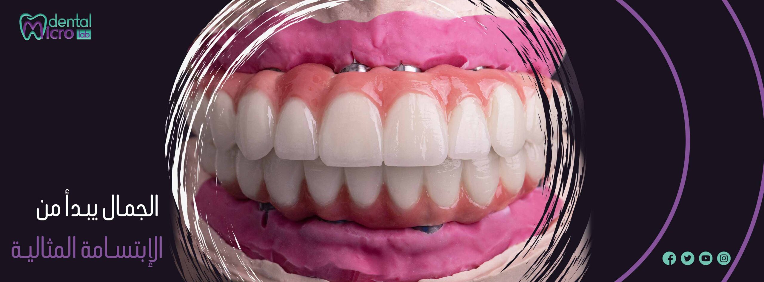 تركيبات إيماكس فينير إيماكس معمل أسنان جدة تركيبات تجميلية معمل تركيبات أسنان