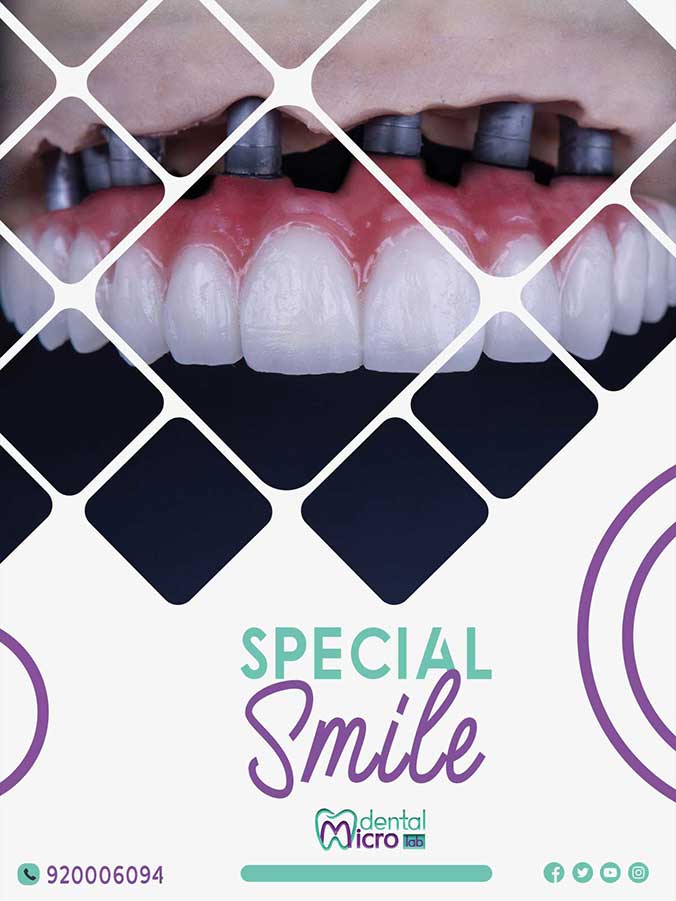 تركيبات إيماكس فينير إيماكس معمل أسنان جدة تركيبات تجميلية معمل تركيبات أسنان