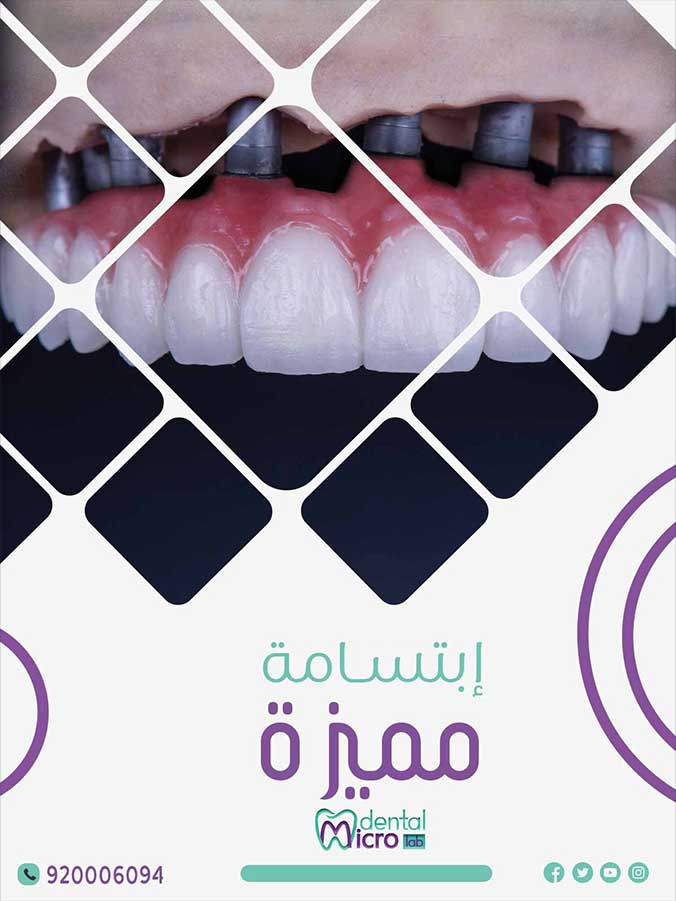 تركيبات إيماكس فينير إيماكس معمل أسنان جدة تركيبات تجميلية معمل تركيبات أسنان